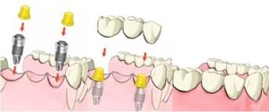 dental implant or bridge treatment