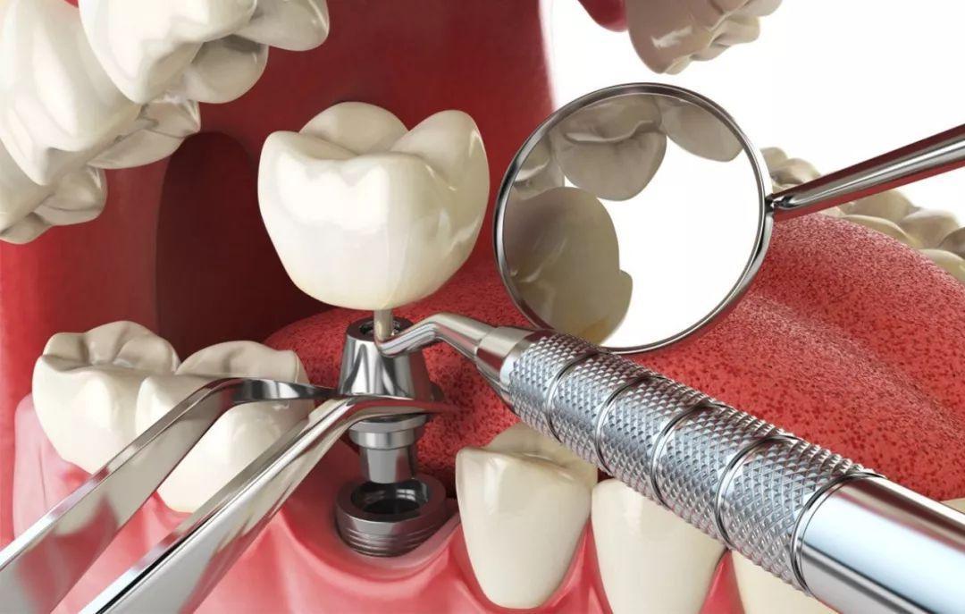 dental implant treatment in clinic