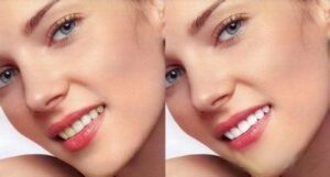 tips of teeth whitening