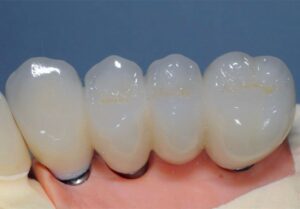 CAD CAM Dental zirconia cosmetics