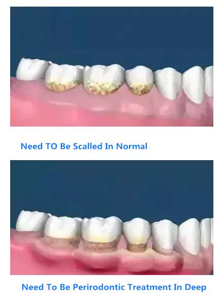 Two Case on Periodontic treatment