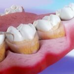 periodontal curettage treatment