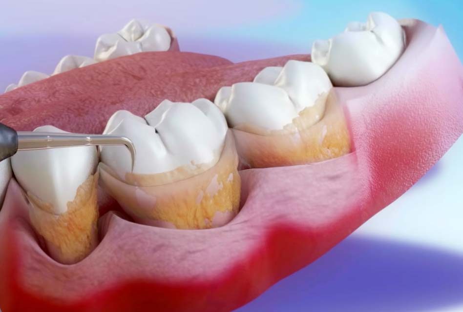 periodontal curettage treatment