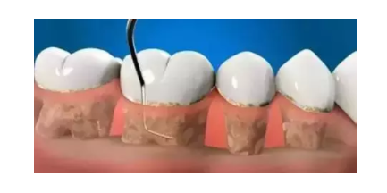 periodontal curettage