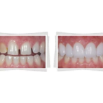 porcelain and zirconia teeth comparasion
