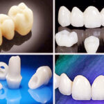 types of dental crowns