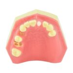 Maxillary Exodontia Simulation Model
