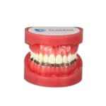 Study Model with Brackets