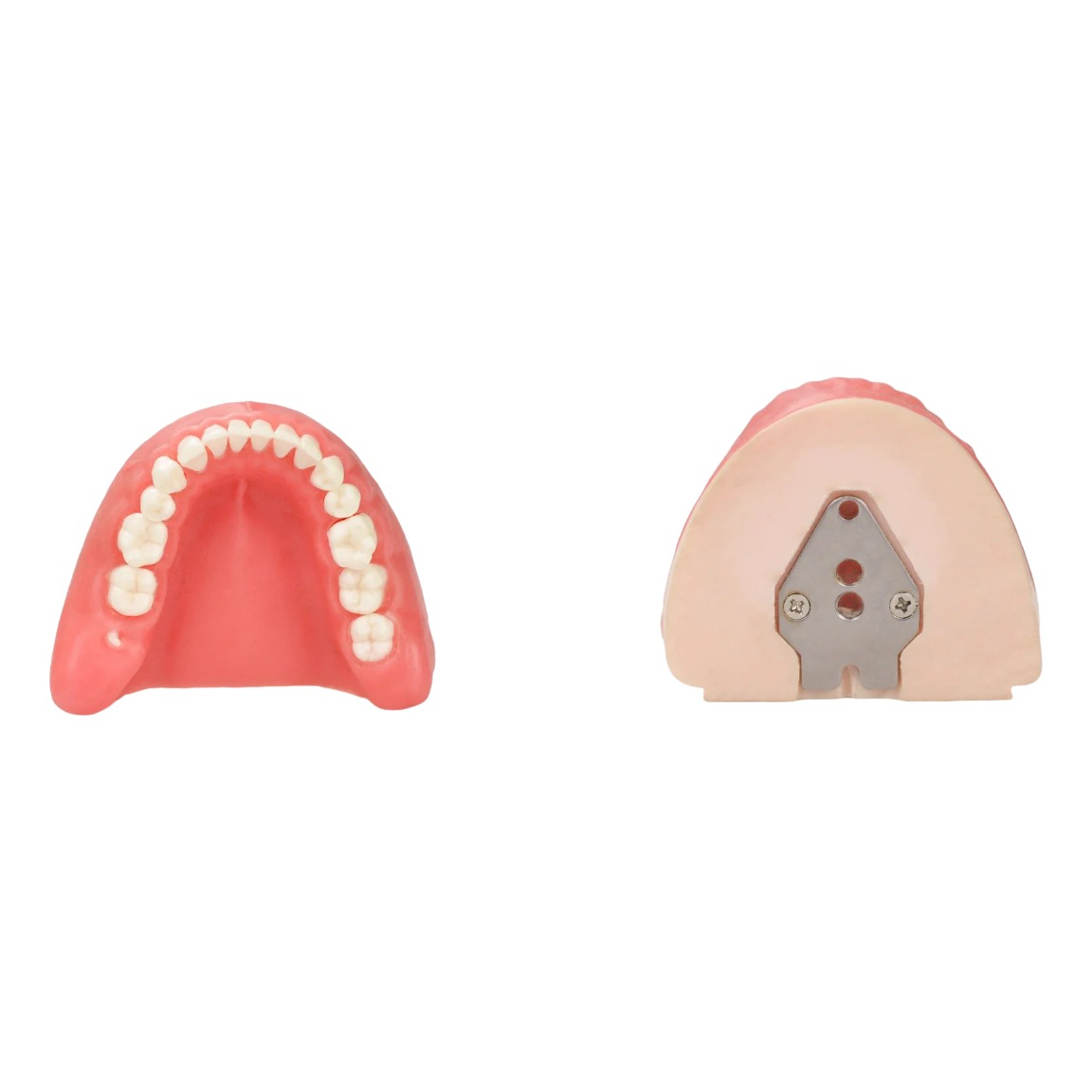 Extraction Typodont for Wisdom Tooth Removal Training - Image 2