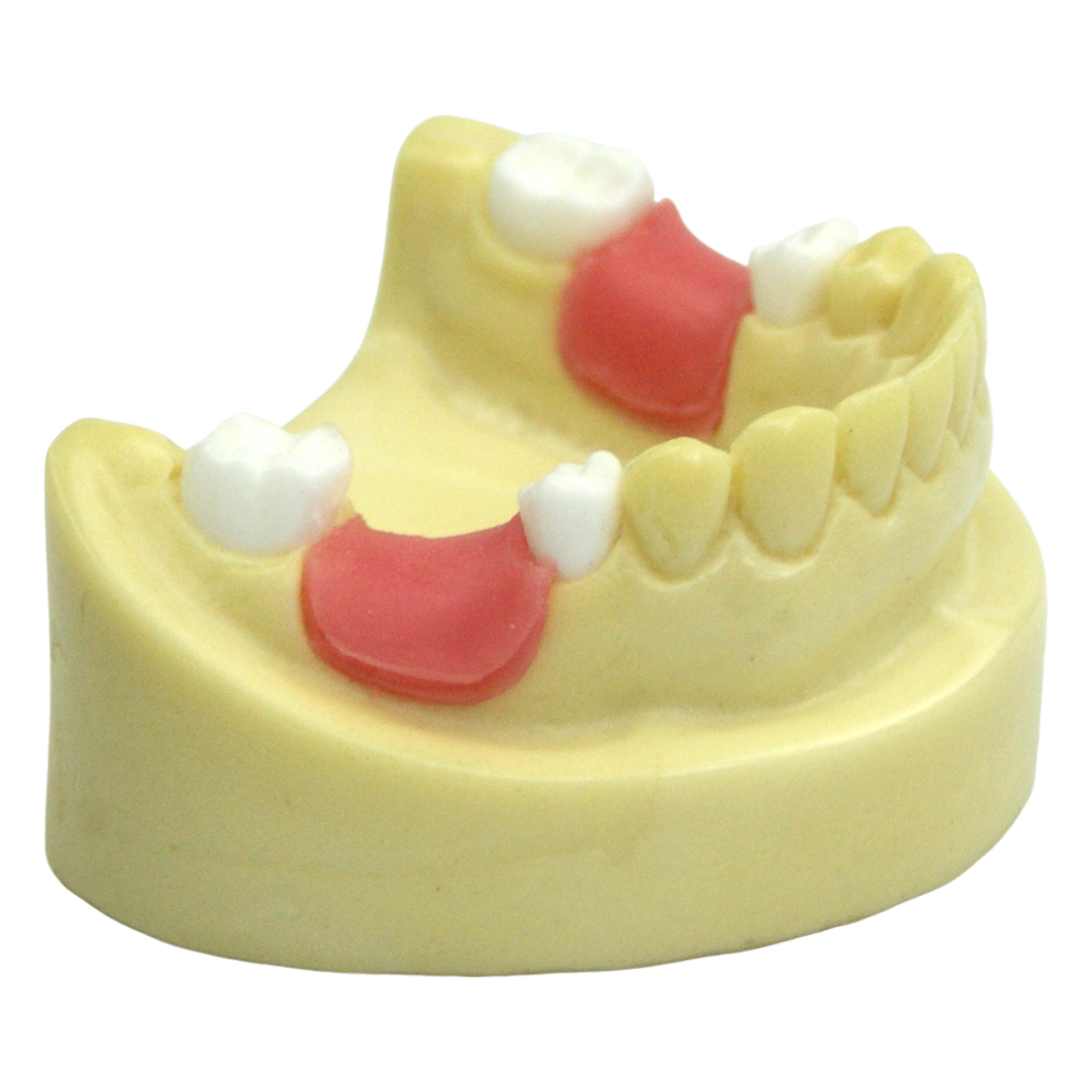 TYU-A25-19-G-implant trainning model with missing tooth